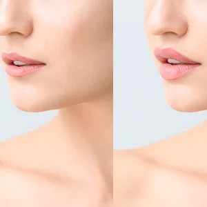filler-labbra